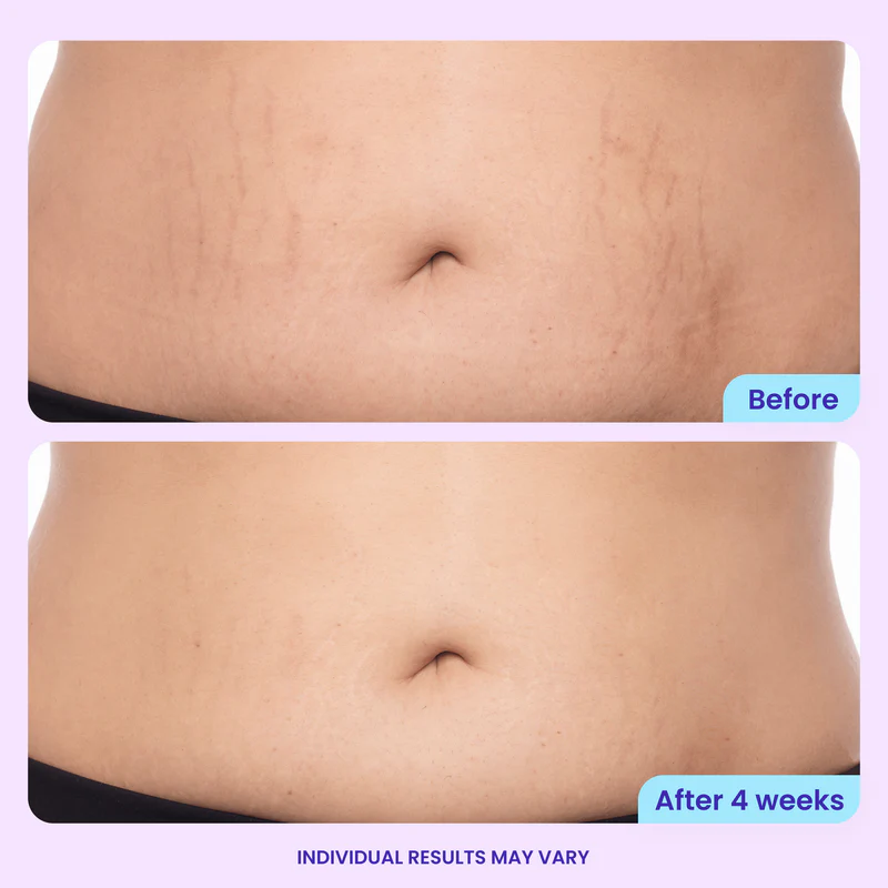Mirevyn✨Last Day Buy 1 Get 1 Free✨Tighten & Smooth Belly Firming Cream