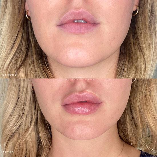 NESLEMY ✨ Last Day Buy 1 Get 1 Free 👄Hydrating Collagen Mouth Tape