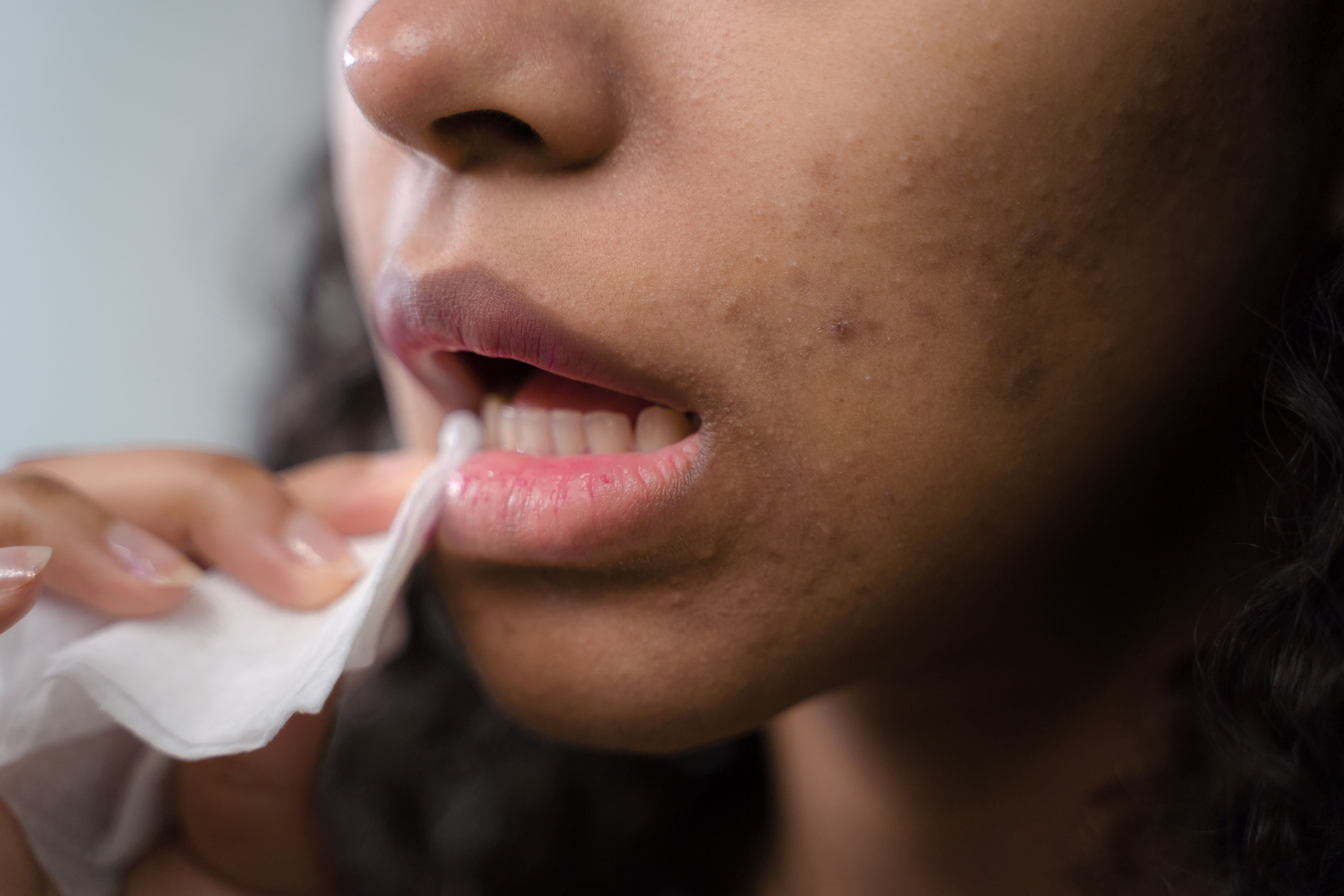 Dry and flaky lips